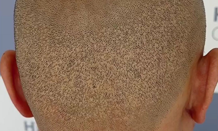 植发后枕区多久可以纹发? 植发后枕区多久可以纹发?