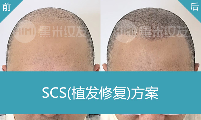植发后又掉了？重庆叶先生4000单位植发失败，黑米纹发修复实录