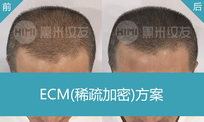 孙先生头发稀疏，米诺地尔无效，选择济南黑米纹发加密头发