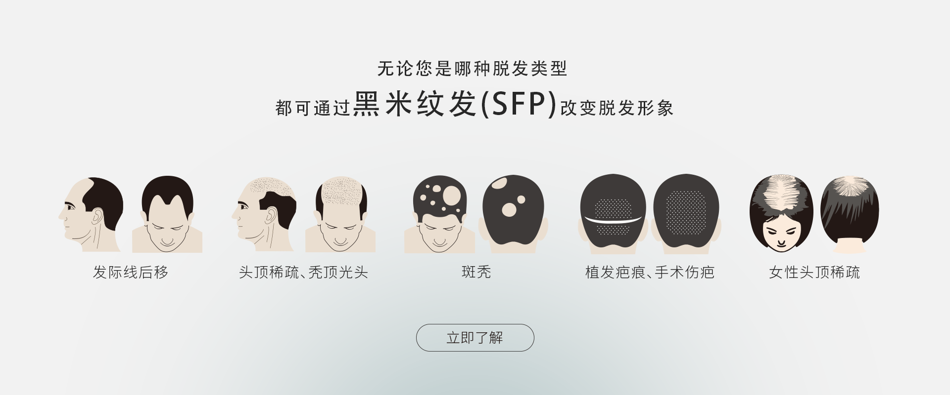 无论您是哪种脱发类型,都可通过黑米纹发(SFP)改变脱发形象