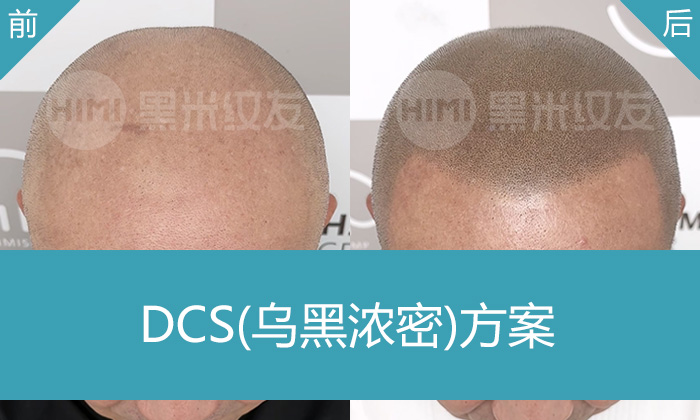 北京黑米纹发真实案例：黄先生从