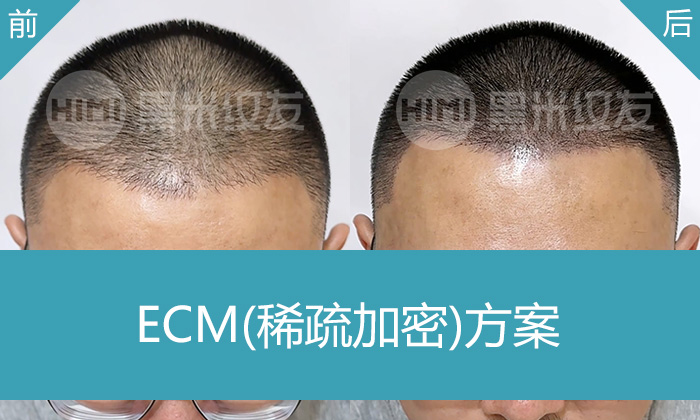 头顶稀疏见头皮？沈阳曹先生纹发加密5年脱发困扰
