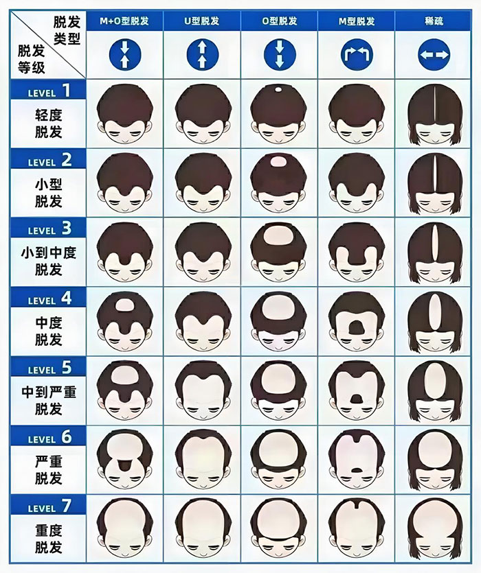 脱发分级:汉密尔顿-诺伍德分级法 脱发分级:汉密尔顿-诺伍德分级法