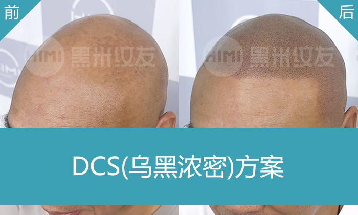 武汉黑米纹发解决15年秃顶困扰，张先生纹发后秒变浓密寸头显年轻