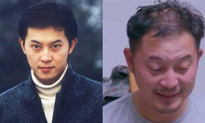 明星脱发一般用什么？