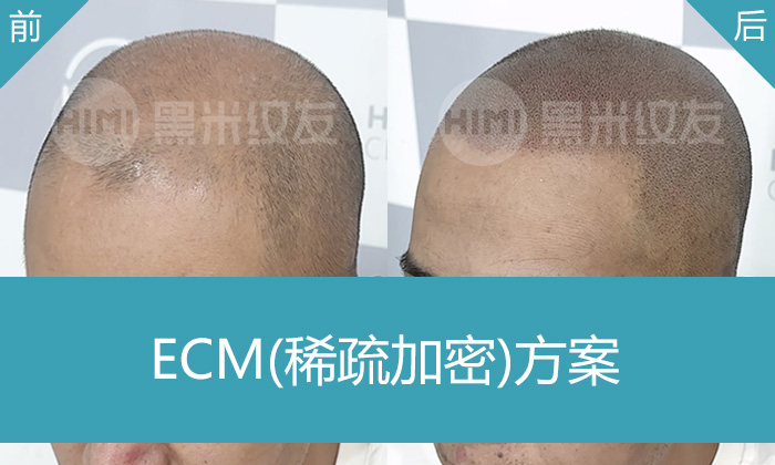 脱发8年无效？陈先生武汉黑米纹发真实案例，头顶加密效果对比惊喜