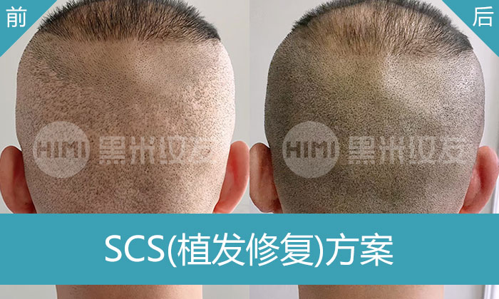 唐先生两次植发留疤心灰意冷，黑米纹发修复后脑勺疤痕