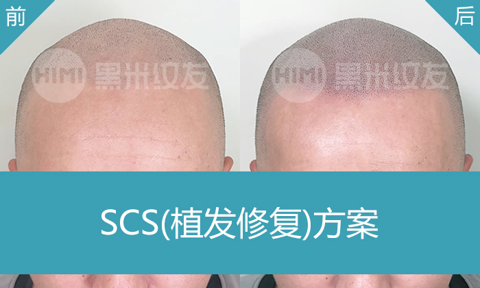 林先生植发失败3000单位后头顶稀疏？广州黑米纹发修复，纹出干练短寸