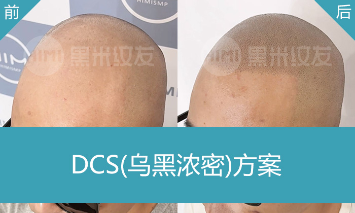 济南秃顶纹发选哪家？黑米纹发帮赵先生解决10年脱发