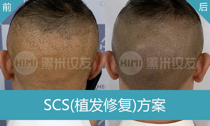 黄先生3次植发留疤，济南黑米纹发植发疤痕修复成功遮盖