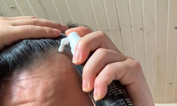 米诺地尔停药会脱发吗? 米诺地尔停药会脱发吗?