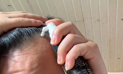 米诺地尔停药会脱发吗？停用后的影响与纹发解决方案