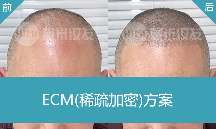 向先生10年M角发际线后移纹发案例，武汉黑米纹发真实效果