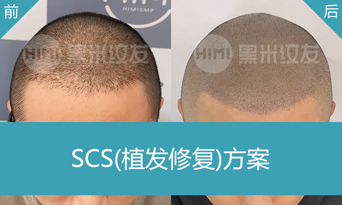 王先生植发失败补救新选择 | 黑米纹发加密让头发重获浓密