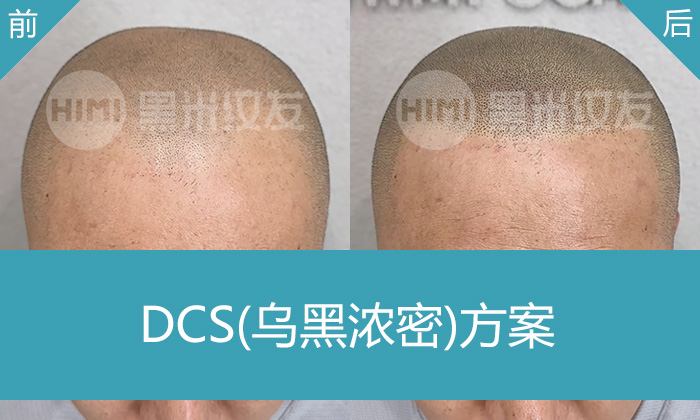 长春李先生选黑米纹发,解决M角后移+发旋稀疏,寸头效果赞