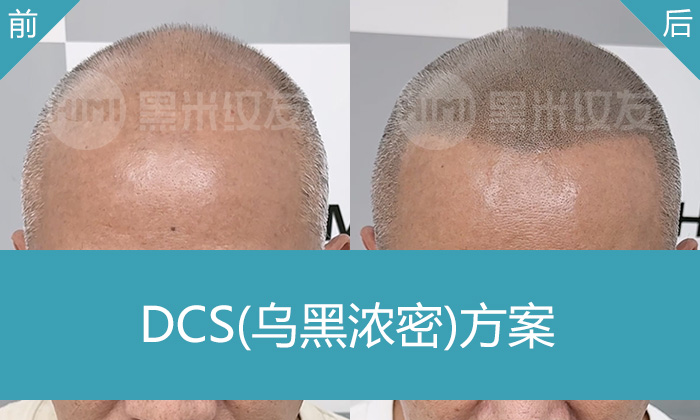 重庆黑米纹发案例：廖先生脱发20年秃顶，纹发后获浓密寸头压制白发显年轻
