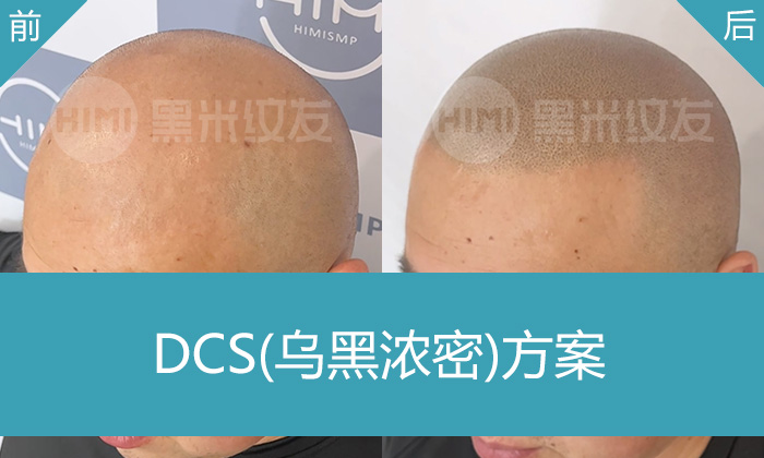 焦先生十年脱发困扰,济南黑米纹发案例见证秃头变浓密寸头