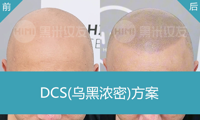 阿先生8年秃顶终改善！重庆黑米纹发门店定制方案，效果看得见