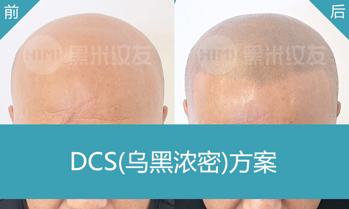 脱发20年头顶无毛？重庆黑米纹发案例：戴先生纹发后秒变浓密寸头