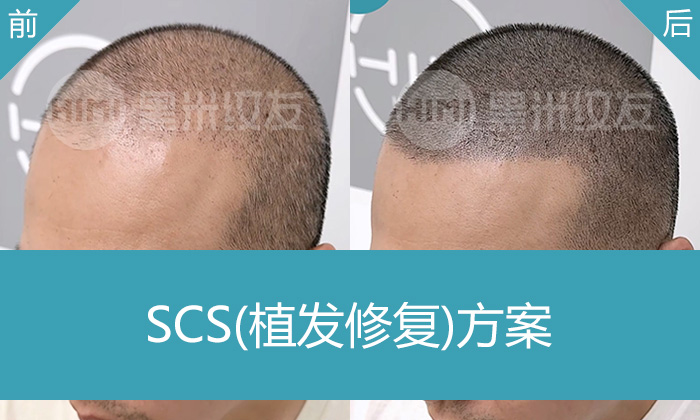 刘先生头发稀疏M角后移又植发失败，重庆黑米纹发改变形象