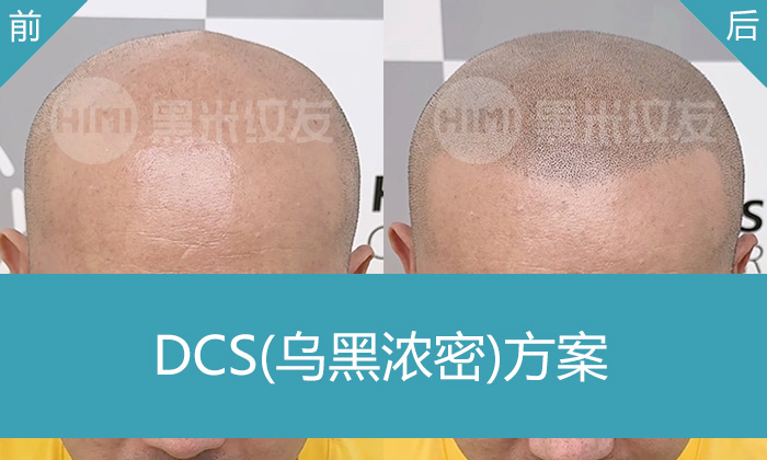 重庆秃顶纹发选黑米！罗先生试过多种方法无效，纹发后形象大变