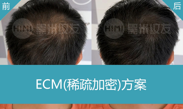 广州纹发修复脱发案例｜廖先生3年脱发，发旋稀疏加密效果实录
