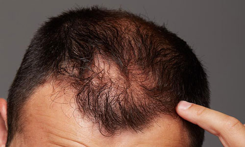 头顶稀疏不用慌！3大方法让头发显浓密，纹发加密成优选