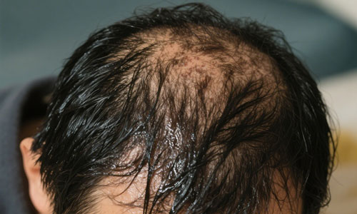 脱发且头顶出汗多能纹发吗？一文解锁纹发真相