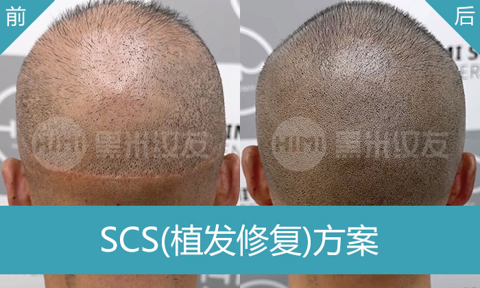 李先生10年脱发+植发失败？重庆黑米纹发定制方案，让头顶浓密、疤痕隐形