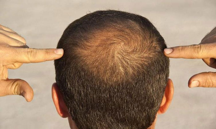 头顶稀疏的男性 头顶稀疏的男性