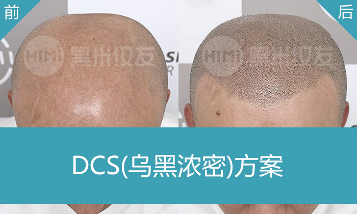 李先生10年脱发困扰，黑米纹发秃顶变浓密寸头，年轻几岁