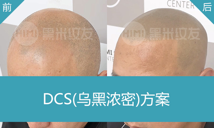 头顶脱发严重？北京黑米纹发帮冯先生摆脱困扰，重拾自信