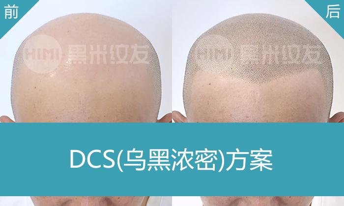 王先生秃顶逆袭,重庆黑米纹发让他从光秃到寸头型男的蜕变