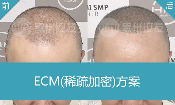 头发稀疏头皮明显?闫先生选北京黑米纹发,10年脱发一次纹发解决