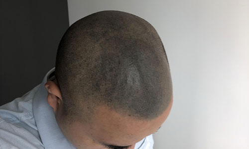 纹发纹毁了?揭秘失败原因与专业机构选择指南