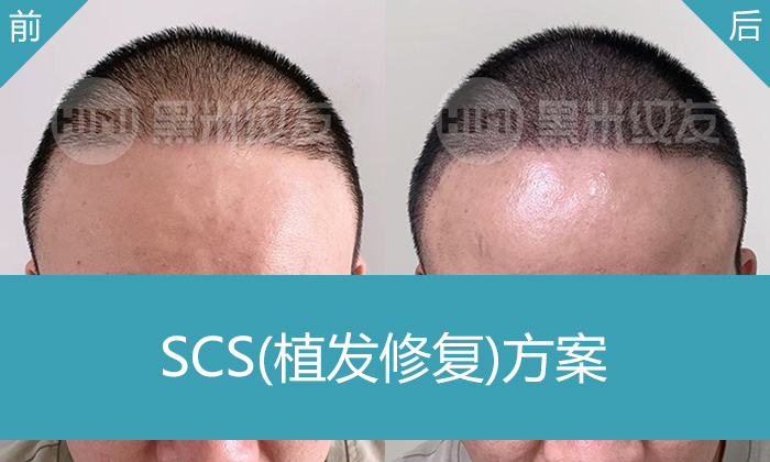 植发失败不用愁！广州黑米纹发帮庄先生解决5年脱发 + 植发稀疏问题