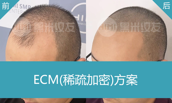 武先生M角发际线头顶稀疏加密，在济南黑米纹发得到改变