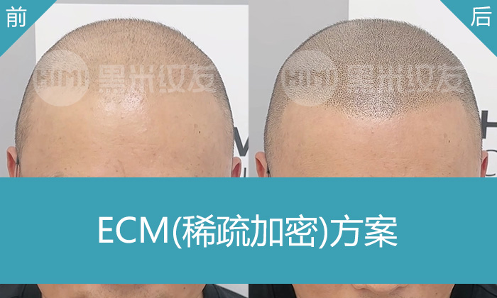 唐先生10年脱发，头顶稀疏严重终解决！重庆黑米纹发浓密重生