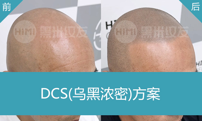 李先生脱发秃顶20年，在重庆黑米纹发变浓密寸头，重拾自信