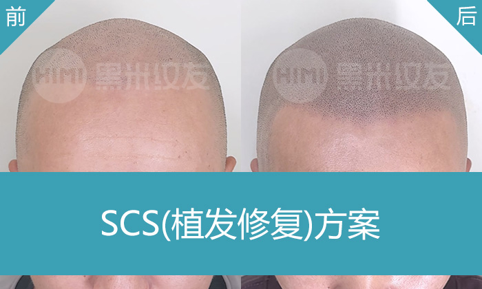 林先生脱发5年发际线后移植发失败,去广州黑米纹发后头顶稀疏变浓密