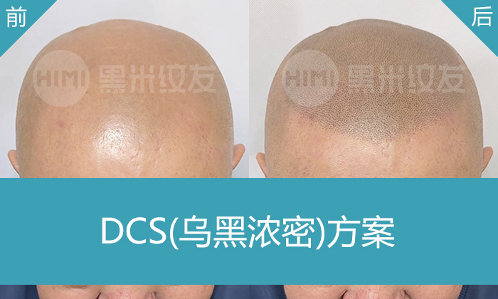 廖先生脱发秃头20年,在沈阳黑米纹发变郭德纲老师同款发型