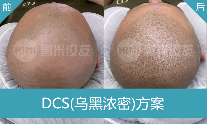 刘先生脱发10年且植发失败怎么办?在济南黑米纹发加密变浓密寸头
