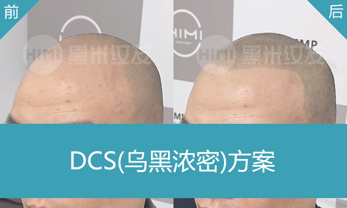 肖先生M型发际线后移头顶稀疏10年，在北京黑米纹发解决问题