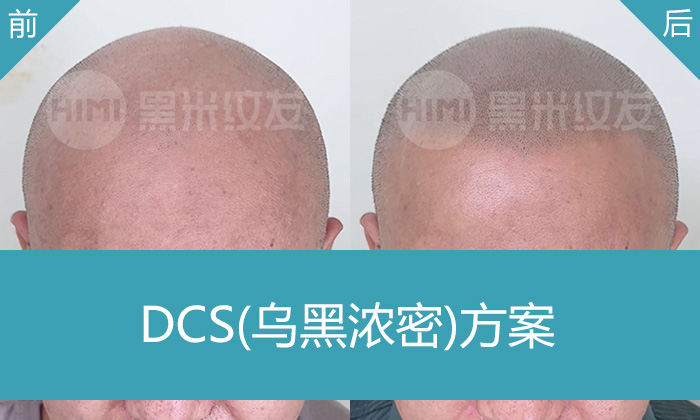 何先生脱发秃顶10年，在广州黑米纹发变浓密寸头