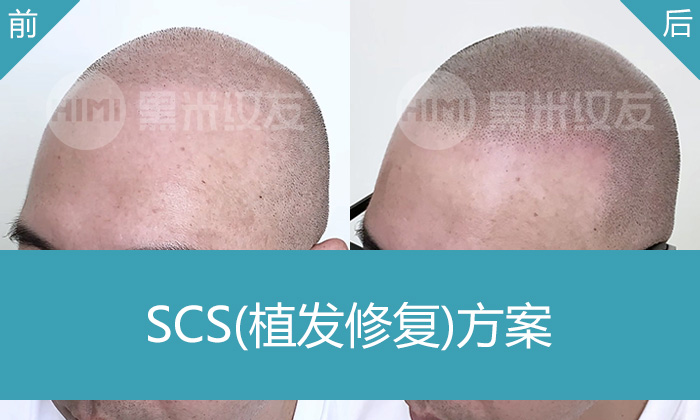 陈先生脱发8年又植发失败，在广州黑米纹发从头顶稀疏变浓密