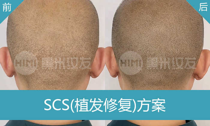 韩先生脱发15年植发失败后脑勺留疤，在济南黑米纹发变浓密寸头
