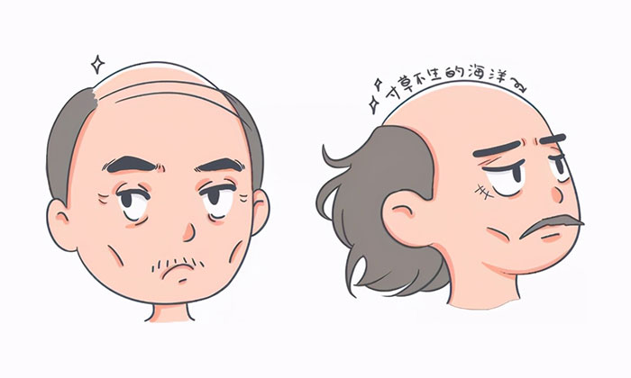 爷爷爸爸脱发秃顶 爷爷爸爸脱发秃顶