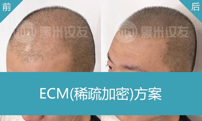 周先生脱发8年头顶整体稀疏，在济南黑米纹发头顶稀疏纹发加密