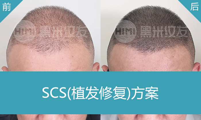周先生脱发10年植发失败头发稀疏，在广州黑米纹发后头顶稀疏变浓密