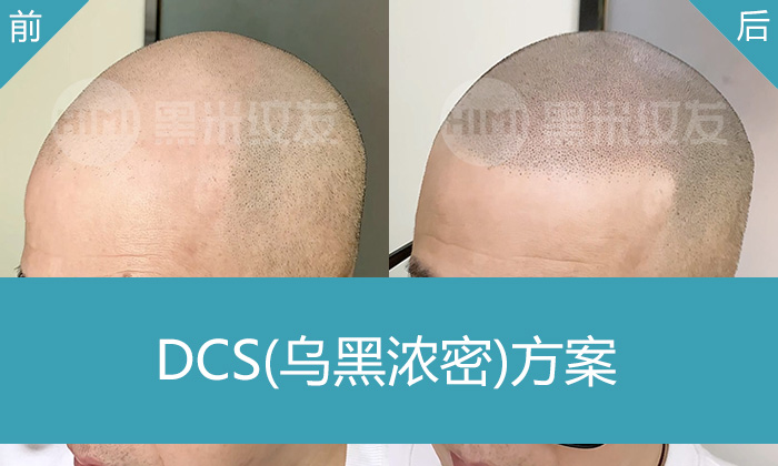 张先生脱发10年大面积秃顶，在济南黑米纹发后变浓密寸头